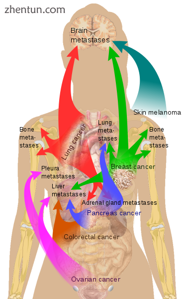 Main sites of metastases for some common cancer types. Primary cancers are.png