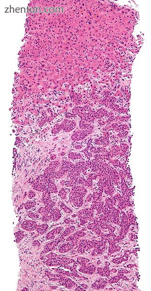 Metastasis proven by liver biopsy (tumor (adenocarcinoma) - lower two-thirds of .jpg