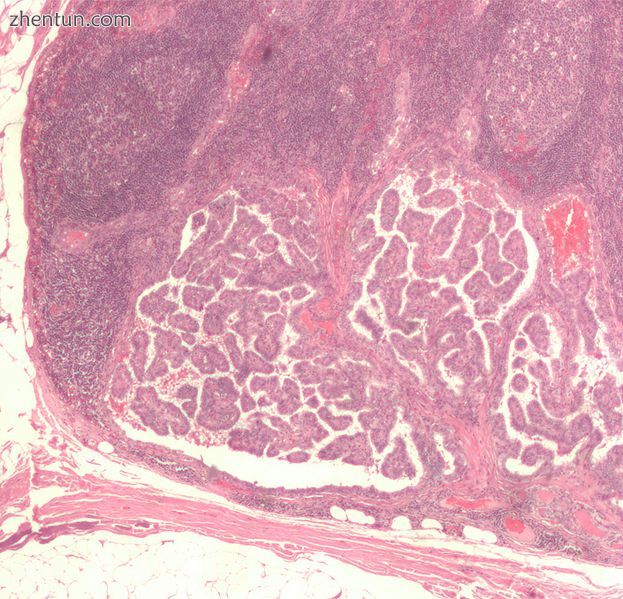 Micrograph of thyroid cancer (papillary thyroid carcinoma) in a lymph node of th.jpg