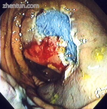 A portion of the polyp is now removed..jpg