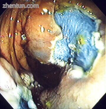 The polyp is fully removed..jpg