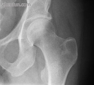Radiograph of a healthy human hip joint.jpg