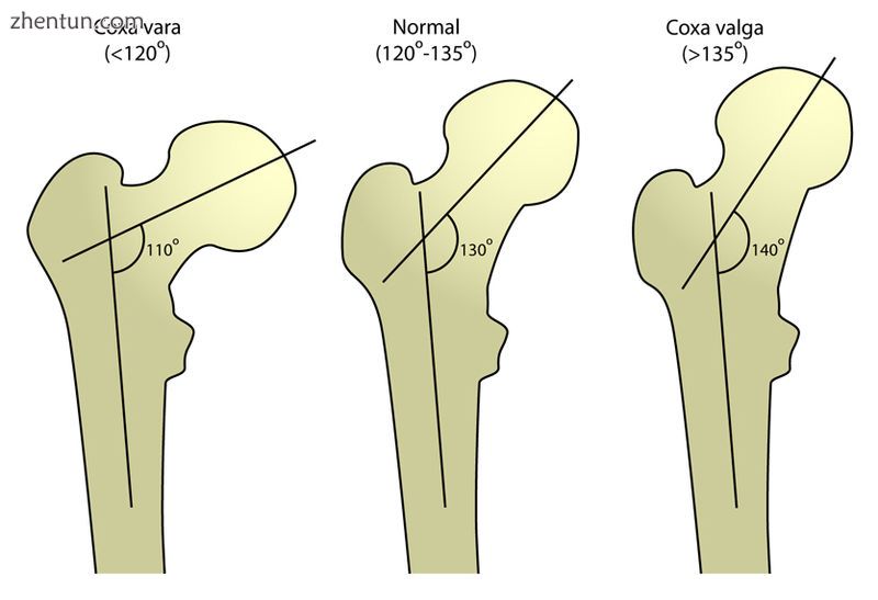 Designations of abnormal femur angles..jpg