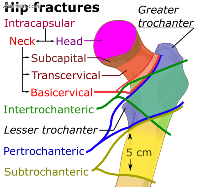 Hip fracture classification.[1].png