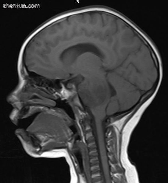 A brainstem glioma in four-year-old. MRI, sagittal, without contrast.jpg
