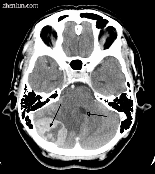 A posterior fossa tumor leading to mass effect and midline shift.png