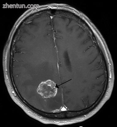 Brain metastasis in the right cerebral hemisphere from lung cancer, shown on mag.jpg
