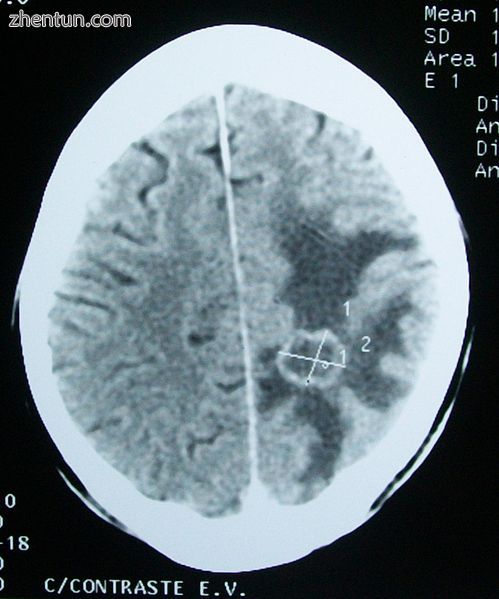 CT scan of a brain tumor, with its diameters marked as an X. There is.jpg