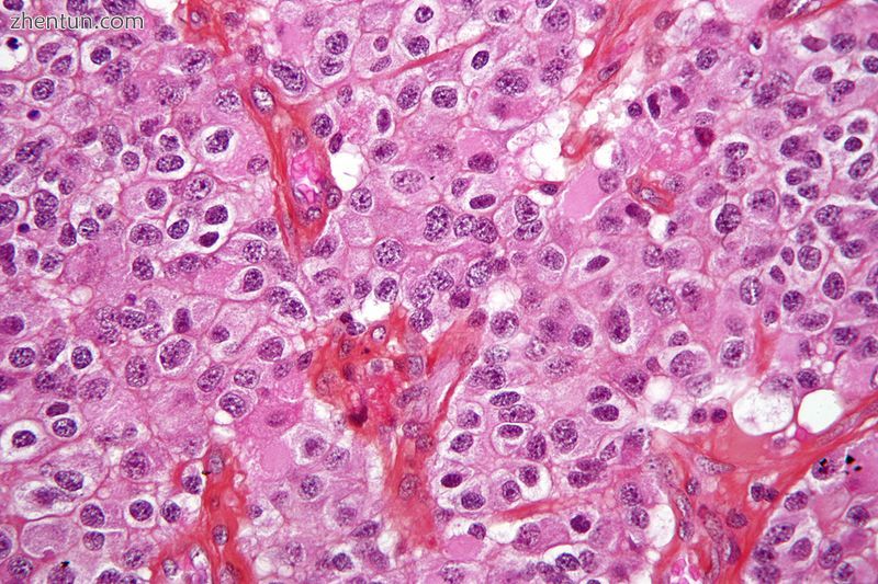 Micrograph of an oligodendroglioma, a type of brain cancer. Brain biopsy. H&amp;E .jpg