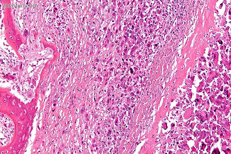 Micrograph of an osteosarcoma, a malignant primary bone tumor..jpg