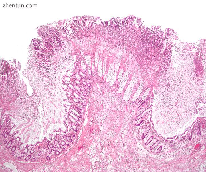 Micrograph of pseudomembranous colitis, an indication for colectomy. H&amp;E stain..jpg