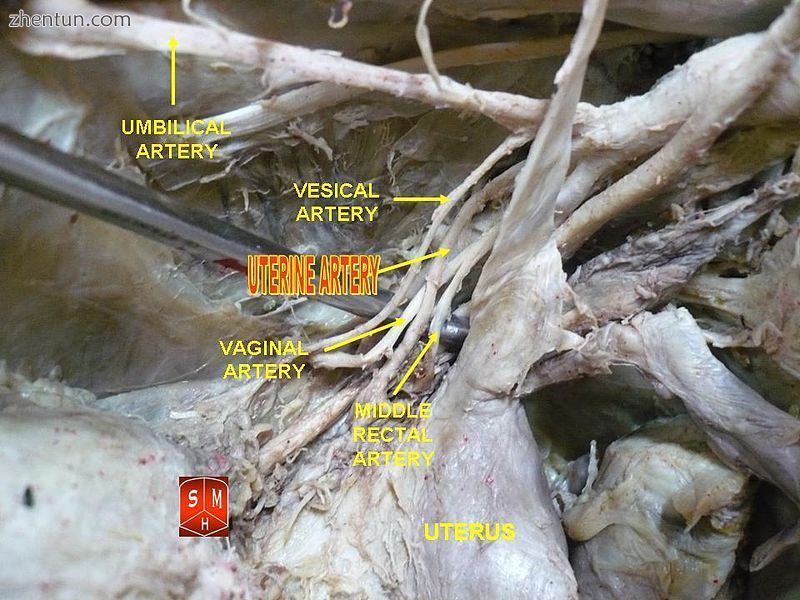 Uterine artery.jpg