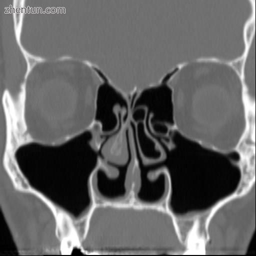 Altered nasal anatomy after bilateral subtotal inferior turbinectomy.jpeg