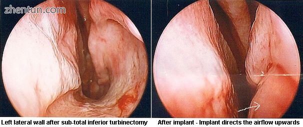 Before and after surgical restoration of the lateral wall (arrow in right-side i.jpg