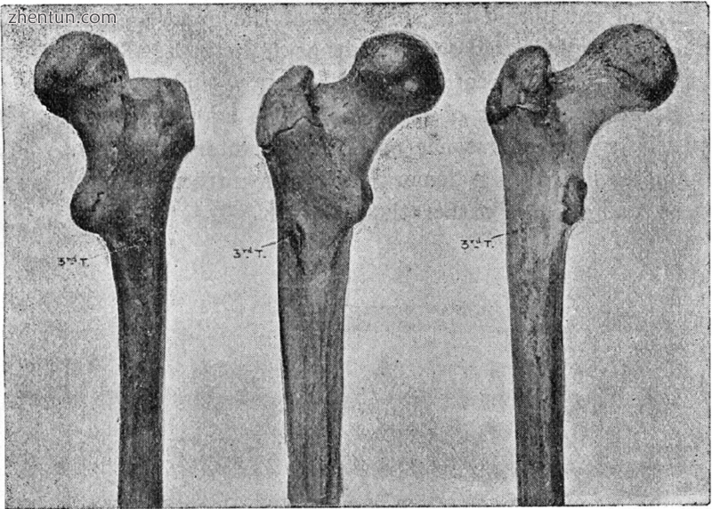 Human femoral bones featuring third trochanters.png
