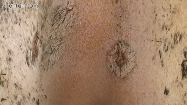 Old lesions, with regrowing hair.jpg