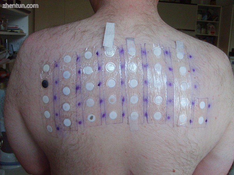 A patch test is sometimes carried out. Areas of the skin on the back are stimula.jpg