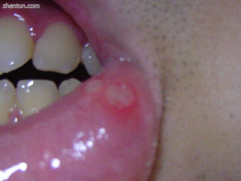 Aphthous ulcers on the labial mucosa (.jpg