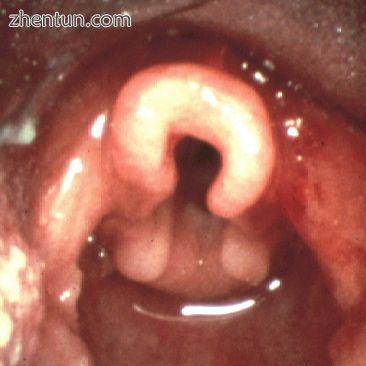 Omega shaped epiglottis, seen in laryngomalacia.jpg