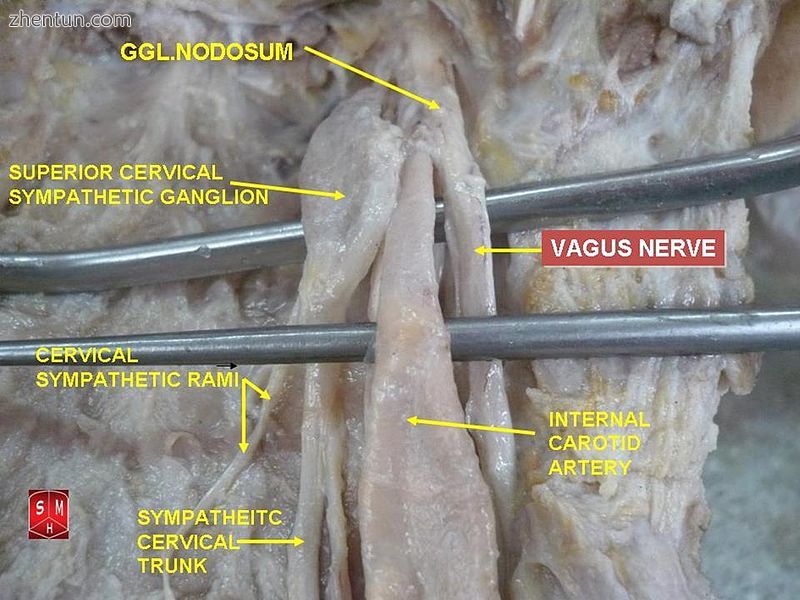 Vagus nerve – dissection.jpg