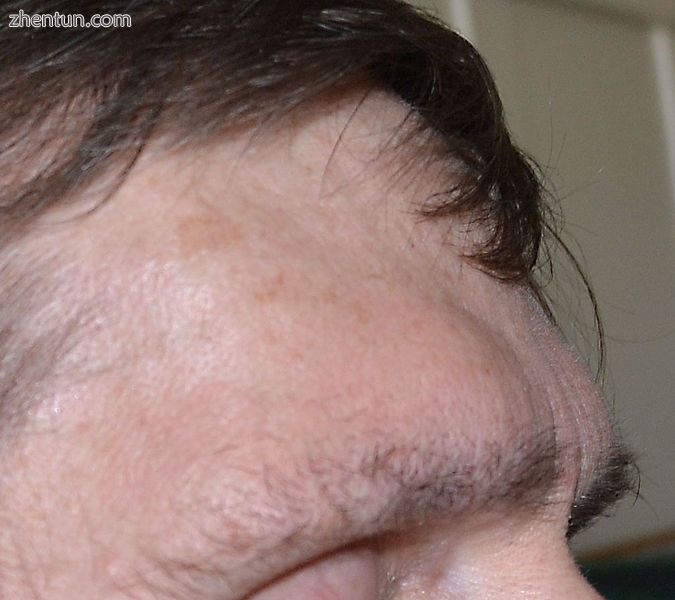 Brow ridge and forehead protrusion remaining after tumor removal and tissue swel.jpg