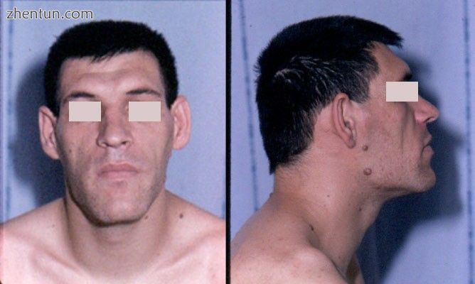 Facial features of a person with acromegaly. The cheekbones are pronounced, the .jpg