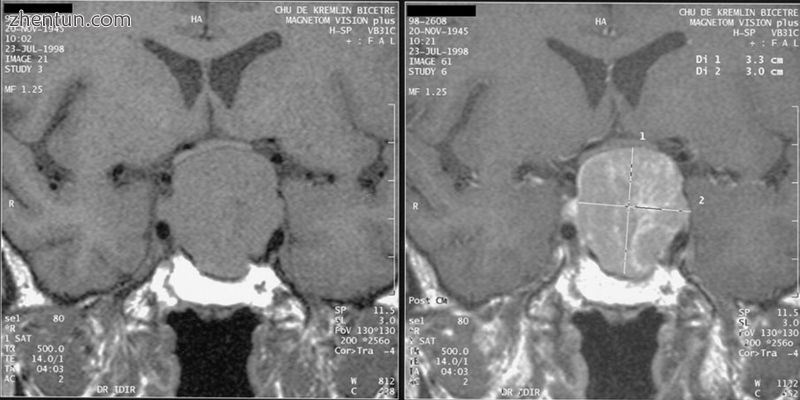 Magnetic resonance image of a pituitary macroadenoma that caused acromegaly with.jpg