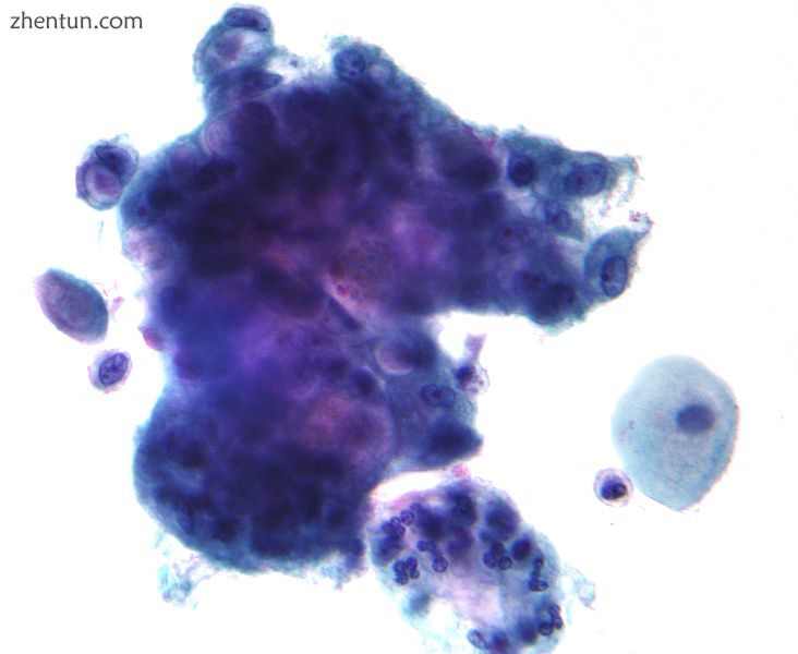 Micrograph of an adenocarcinoma that arose from the endocervical mucosa. Pap stain..jpg