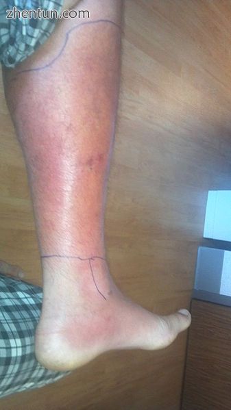 Cellulitis of the leg with foot involvement.jpg