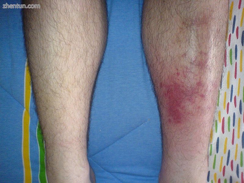 Infected left shin in comparison to shin with no sign of symptoms.jpg