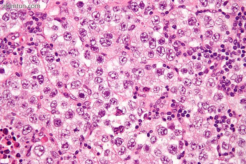 Micrograph of a seminoma, a common germ cell tumor..jpg