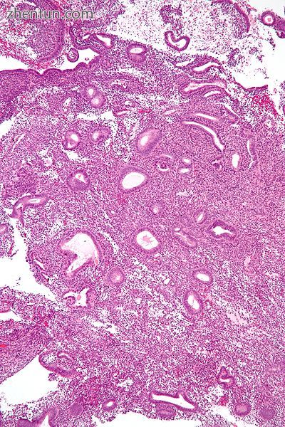 Micrograph showing an endometrial biopsy with simple endometrial h.jpg