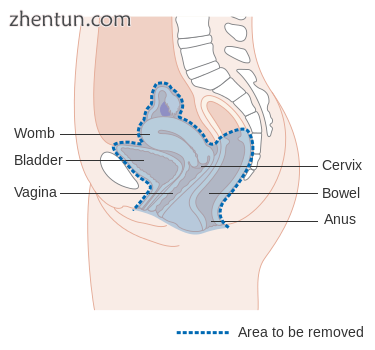 Diagram showing the area removed in a pelvic exenteration in a female.png