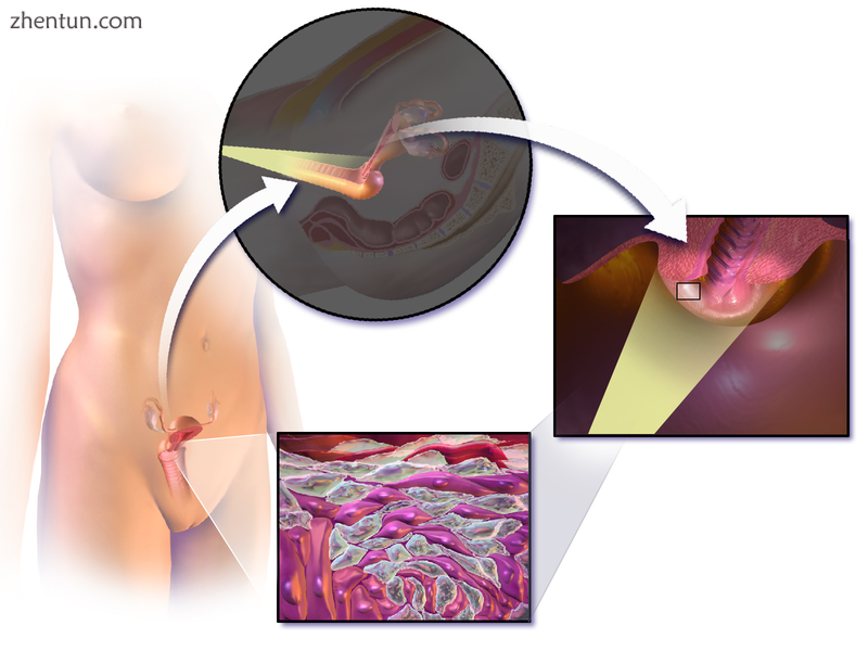 An illustration of a colposcopy procedure..png