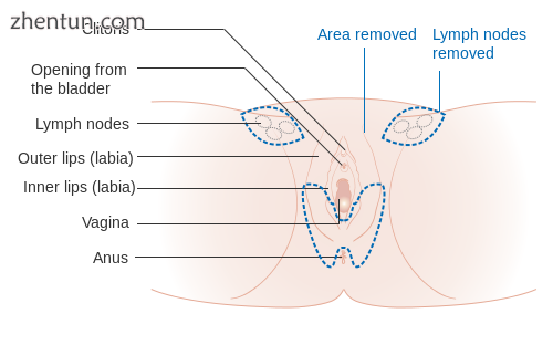 A partial vulvectomy of the bottom area of the vulva.png