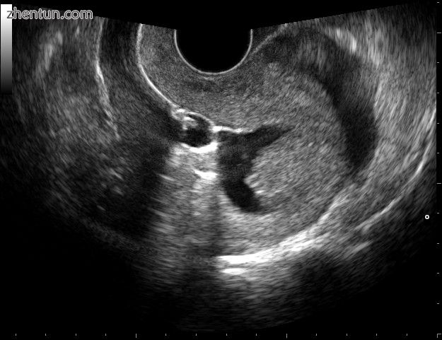 Sonohysterography using a balloon catheter (seen in the middle of the image..jpg