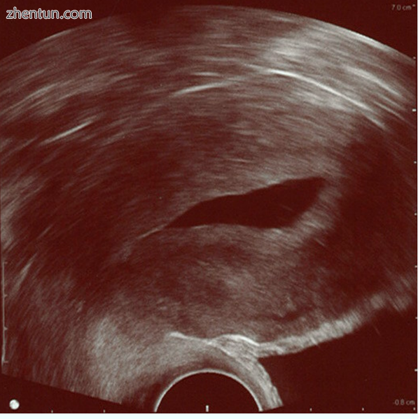 Sonohysterography. The sterile saline instilled into the cavity of the.png