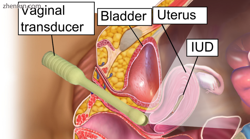 Transvaginal ultrasonography to check the location of an intrauterine device (IUD)..png