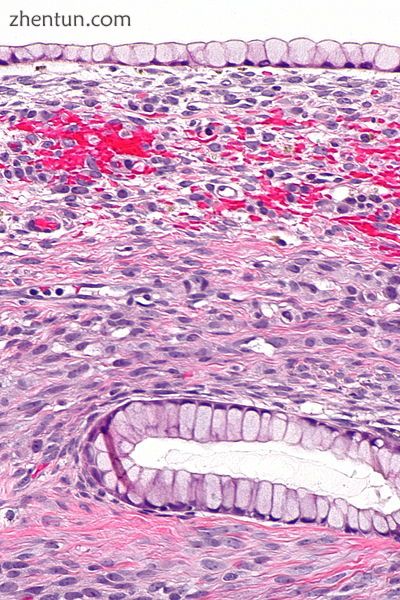 Micrograph showing a mucinous cystadenoma of the 卵巢. H&amp;E stain.jpg