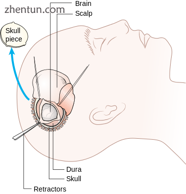 376px-Diagram_showing_a_craniotomy_CRUK_063.svg.png