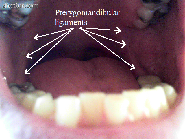 Open mouth, view from front. The pterygomandibular ligaments are marked with arrow.png