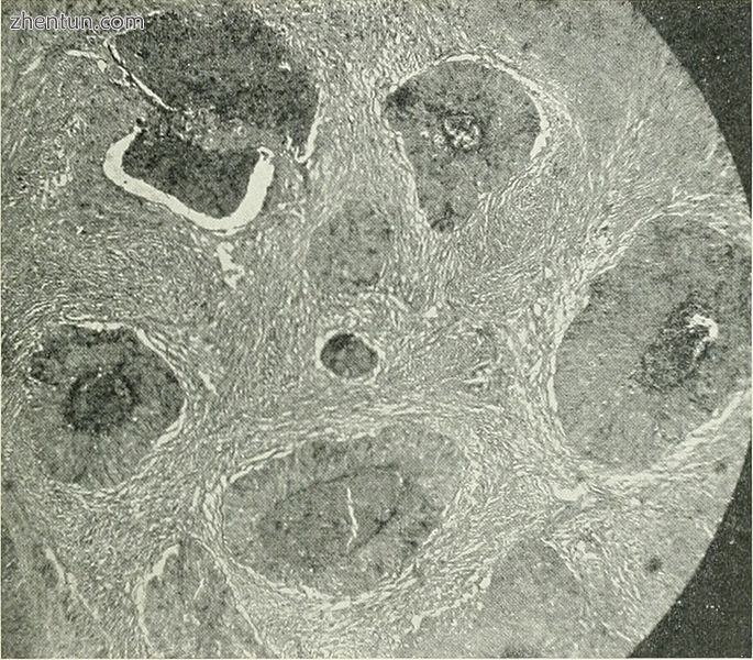 Barthlin carcinoma tissue cross section.jpg