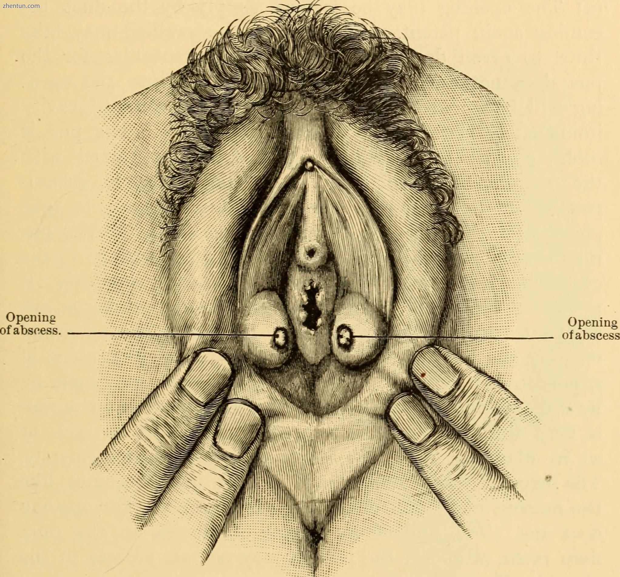 Illustration of Bartholin glands vaginal 脓肿es.[5].jpg