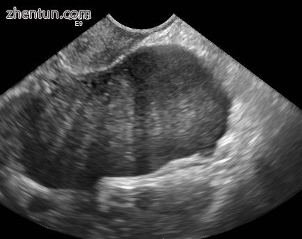ovrian fibroma in ultrasound.jpg