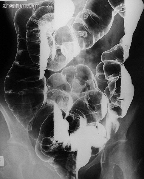 Barium enema radiograph showing multiple polyps (mostly pedunculated) and at lea.jpg