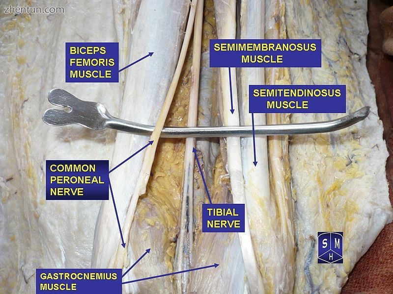 Tibial and common peroneal nerve (aka common fibular nerve).jpg