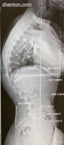 A 20-year-old male with Scheuermann&#039;s disease, showing various measure.jpg
