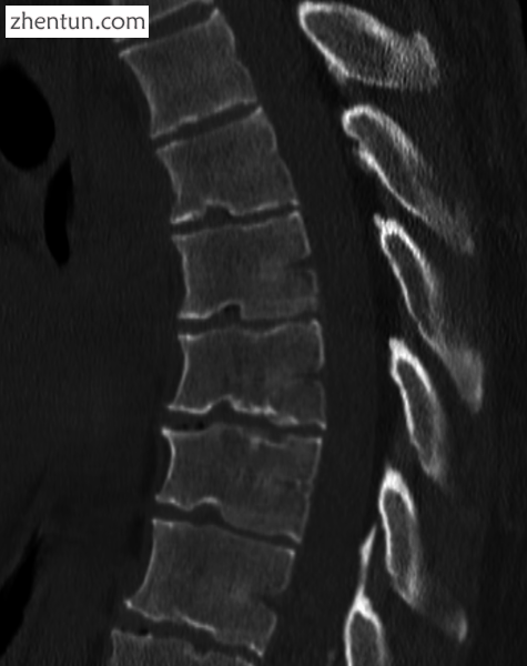 Scheuermann&#039;s disease on lateral CT of the T spine.png
