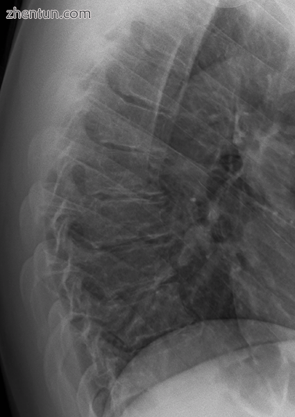 Scheuermann&#039;s disease on lateral Xray of the T spine.png