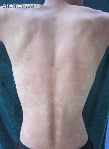 The back of an East Asian man showing alcohol flush reaction..jpg
